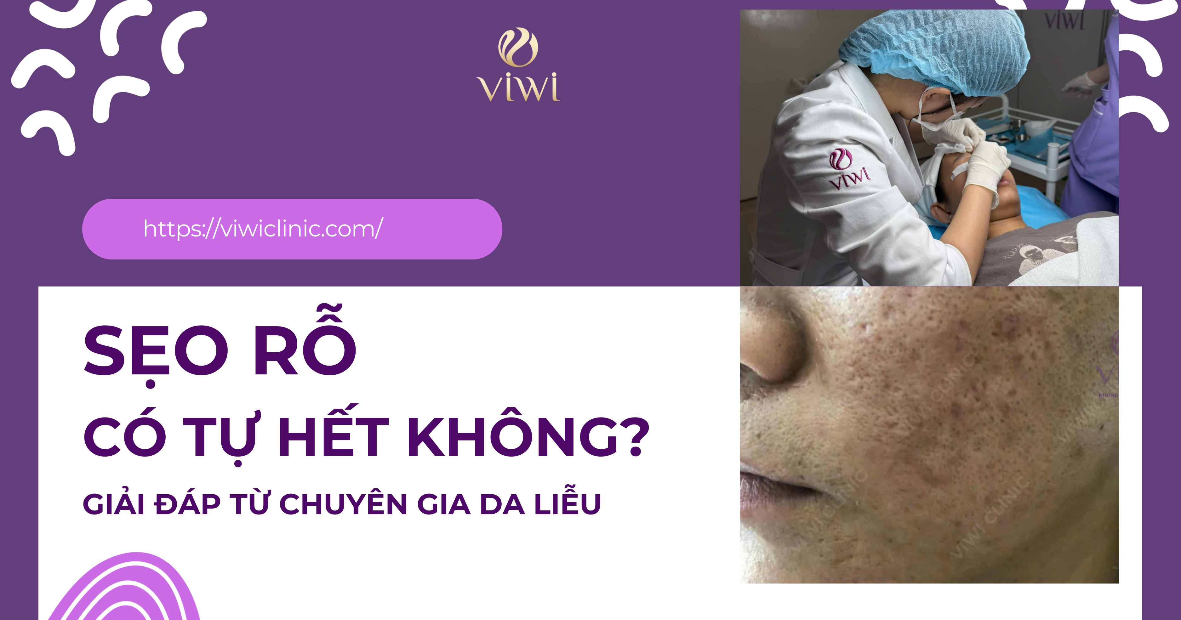 Sẹo rỗ có tự hết không?