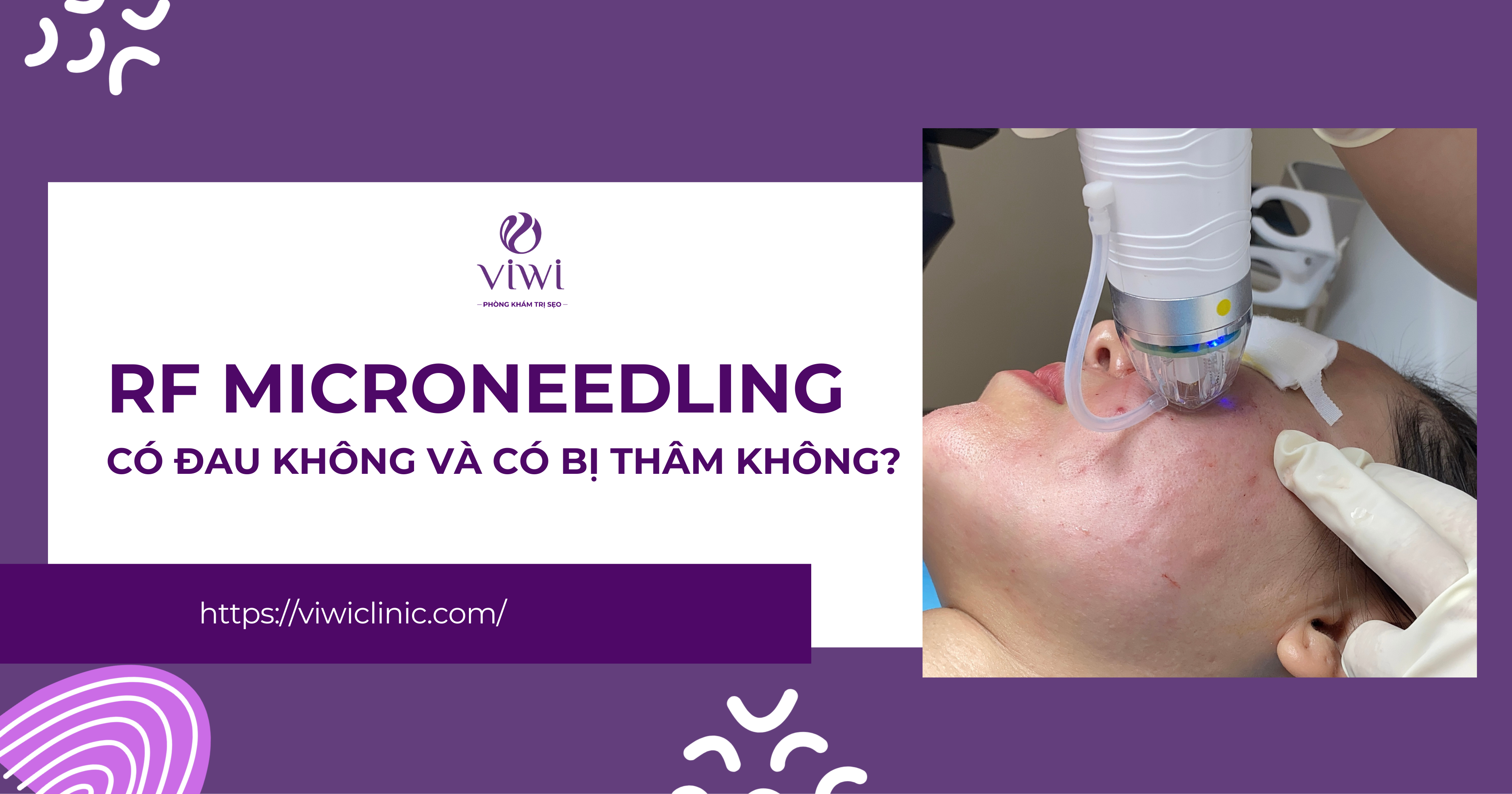 RF Microneedling có đau không và có bị thâm không
